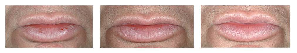 Lanolin effects on lips