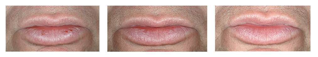 Lanolin effects on lips